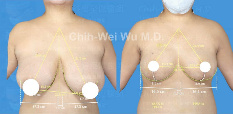 圖片2020年11月最新縮胸手術案例，H罩杯合併下垂與明顯不對稱的胸部，採用倒T切口縮胸手術，達到令人滿意的縮乳效果，縮乳手術權威吳至偉醫師