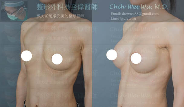 產後隆乳提乳案例，此案例為產後右側胸部萎縮變形，左側則為假性下垂，接受隆乳手術後，達到對稱自然飽滿的胸形
