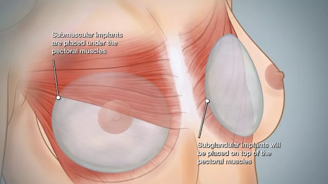 圖片胸大肌下雙平面（左）與乳腺筋膜下（右）的比較