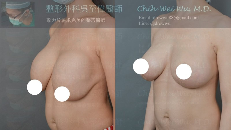 圖片縮胸同時完成假體上胸填補