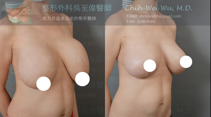 圖片縮胸同時完成假體上胸填補