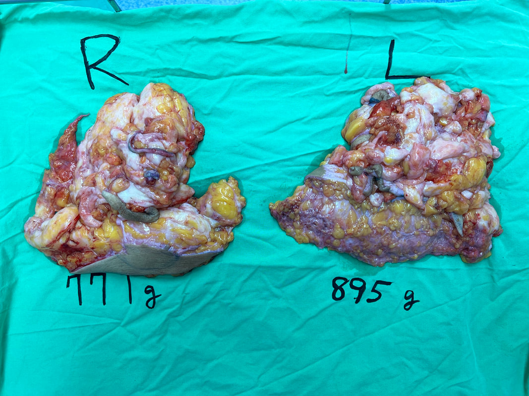 圖片縮胸術中切除的乳腺，右側771克，左側895克，相當於各減少4-5個罩杯。