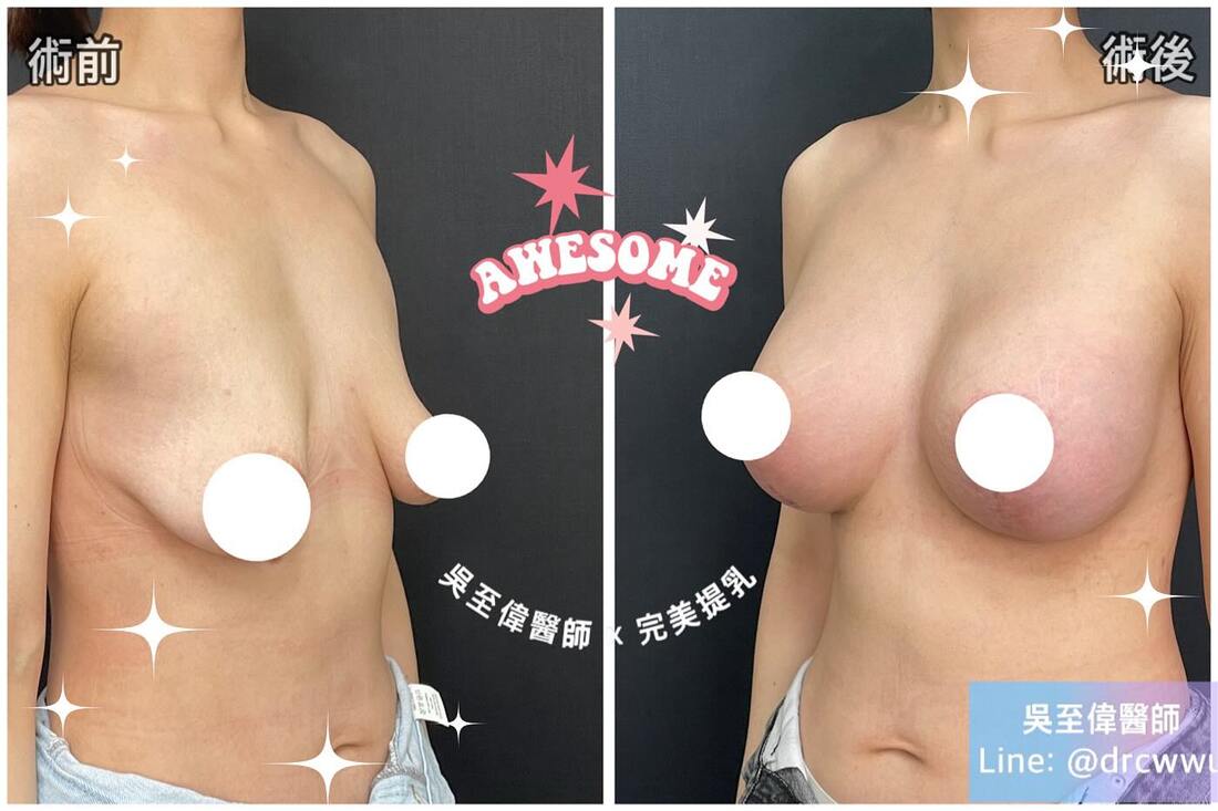 最新提乳案例，在二度下垂，合併上胸嚴重凹陷的胸型，採用垂直切口提乳，合併假體隆乳，可以得到令人滿意的效果〔提乳權威吳至偉醫師〕