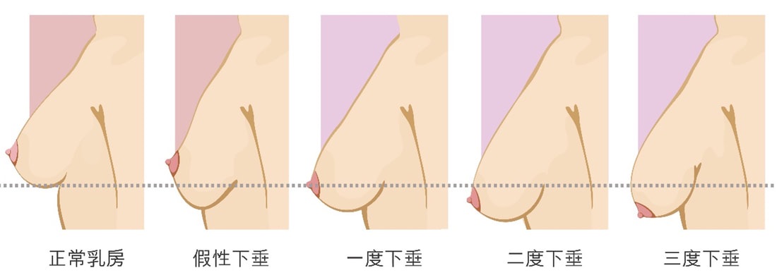 乳房下垂的分級