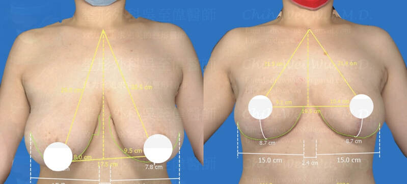 圖片2020年11月最新縮胸手術案例，H罩杯合併下垂與明顯不對稱的胸部，採用倒T切口縮胸手術，達到令人滿意的縮乳效果，縮乳手術權威吳至偉醫師