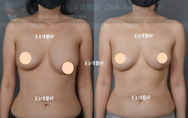 單側提乳，大小胸調整。術前左下垂明顯，提乳術後雙側對稱自然