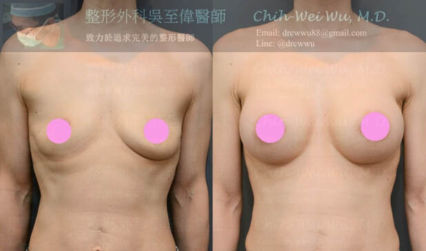 圖片2020年9月最新MOTIVA提乳手術案例；原本的胸部一邊A罩杯，另一邊B罩杯，相差極大且較大的那側下垂明顯，經魔滴提乳隆乳手術，術後胸形豐滿且對稱自然，提乳手術權威推薦