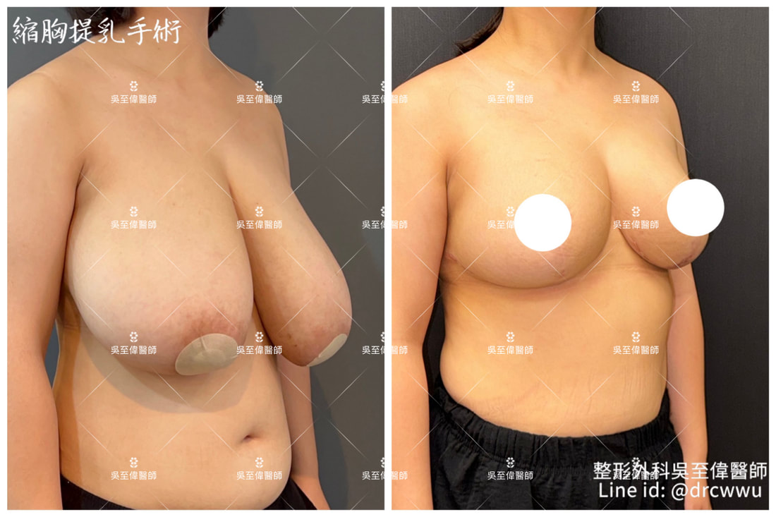 2024年三月更新，縮胸術後一年案例分享，從術前的H/I罩杯，改善到術後的D/E罩杯。縮胸手術權威吳至偉醫師