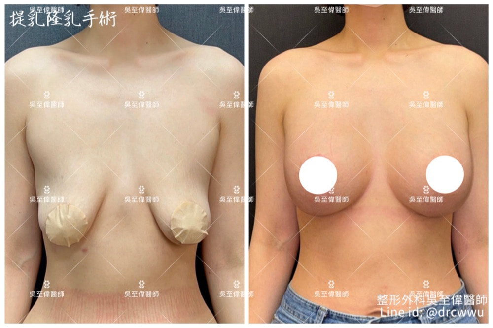 圖片2024年最新提乳案例，案例為二度下垂，手術採棒棒糖垂直切口，合併假體隆乳，術後四個月，胸形上挺，飽滿且呈現自然的弧度〔提乳權威吳至偉醫師〕