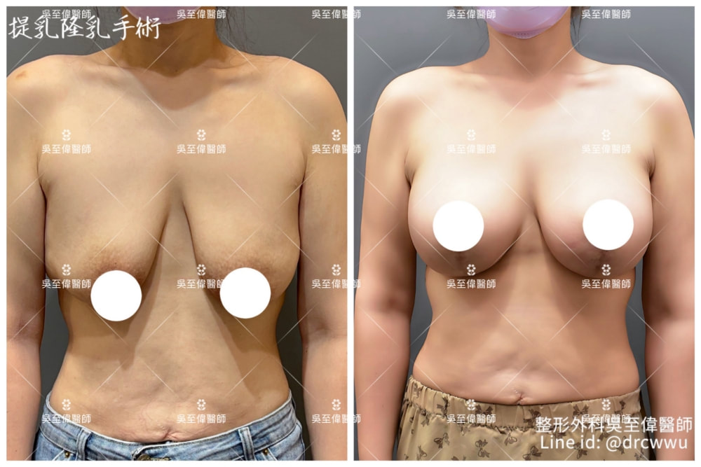2024年最新提乳手術案例，乳房三度嚴重下垂，且上胸凹陷嚴重的案例，採用垂直切口提乳，合併假體隆乳，可以得到令人滿意的結果，此為術後兩個月的效果，疤痕日後會再淡化〔提乳權威吳至偉醫師〕