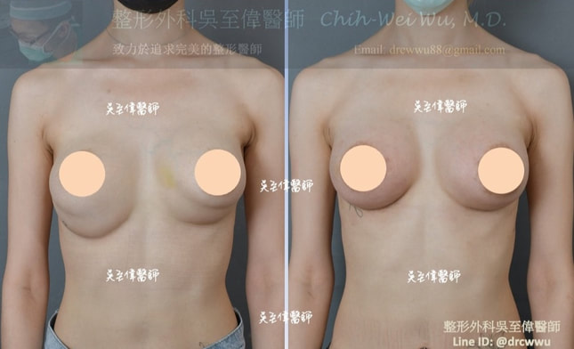 ▲ 此案例為雙層奶，雙泡畸形，高低胸；接受二次隆乳重建修復手術。