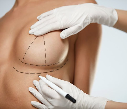 隆乳手術前要做記號定位切口，預計手術範圍與假體置放位置
