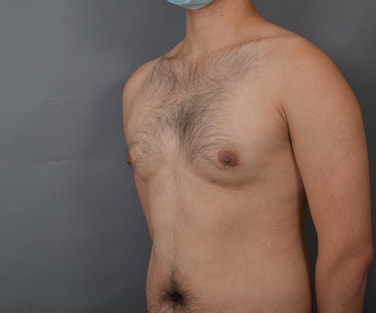 圖片男性女乳手術術前