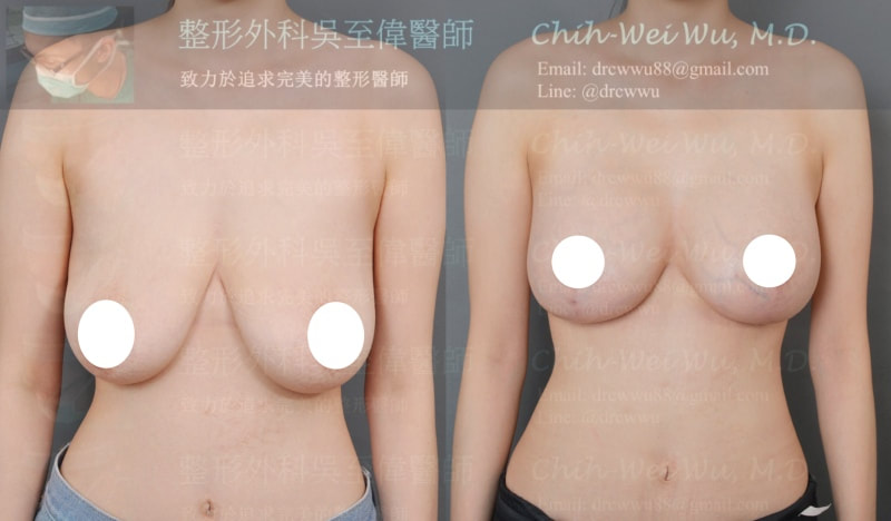 倒t切口合併果凍矽膠提乳