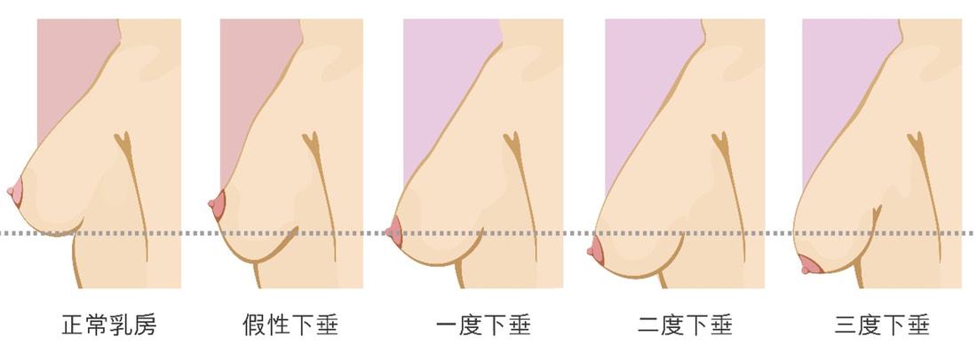 圖片乳房下垂