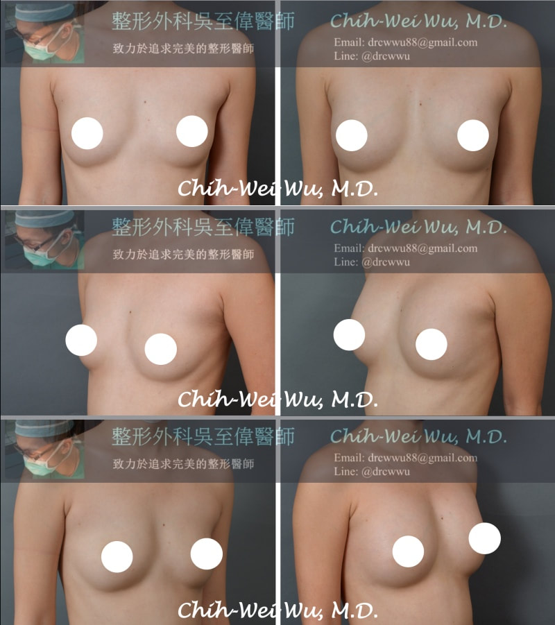 2020年二月自體脂肪隆乳案例
