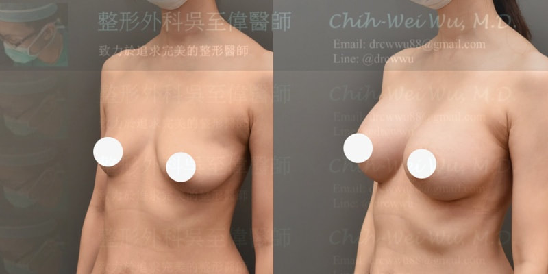 B罩杯隆乳案例照