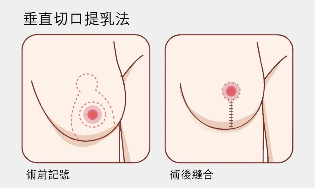 圖片垂直切口棒棒糖提乳示意圖