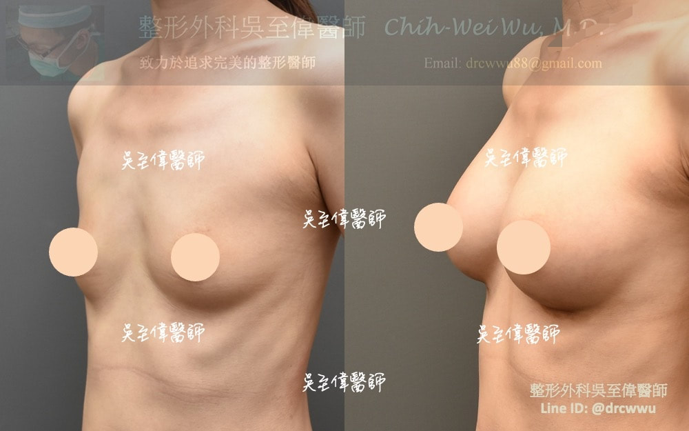 產後隆乳案例，選擇自然而不大的假體，有自然的上胸坡度