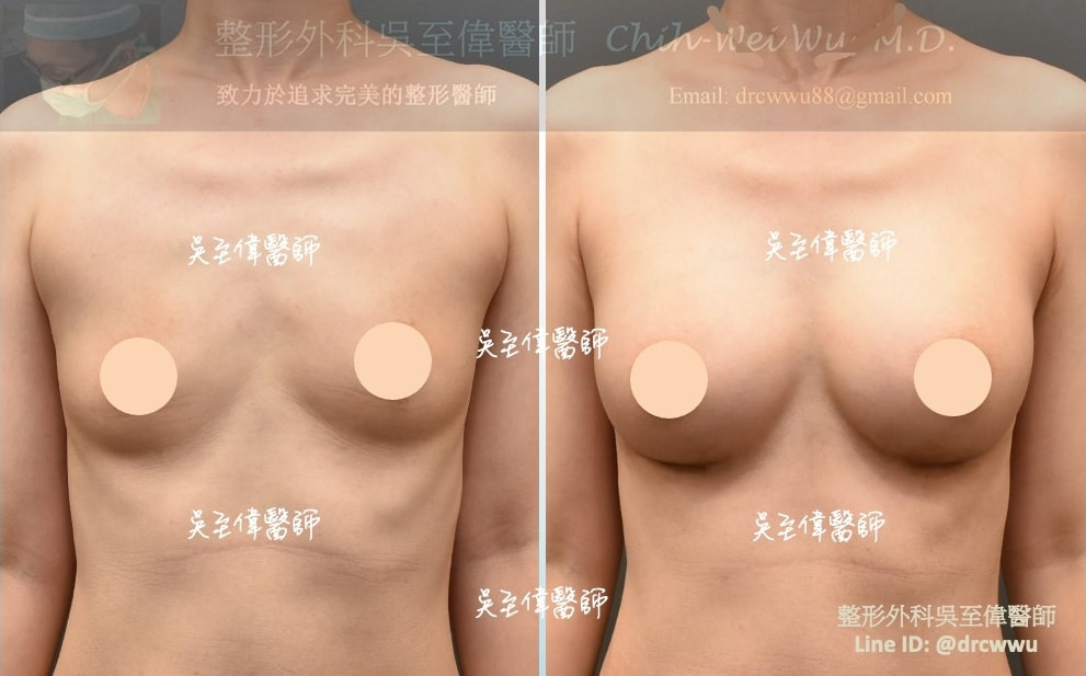 產後隆乳案例，選擇自然而不大的假體，有自然的上胸坡度