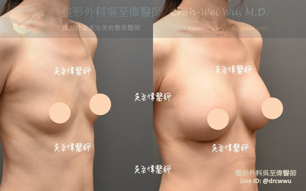 產後隆乳案例，選擇自然而不大的假體，有自然的上胸坡度