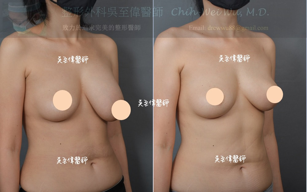 單側提乳，大小胸調整。術前左下垂明顯，提乳術後雙側對稱自然