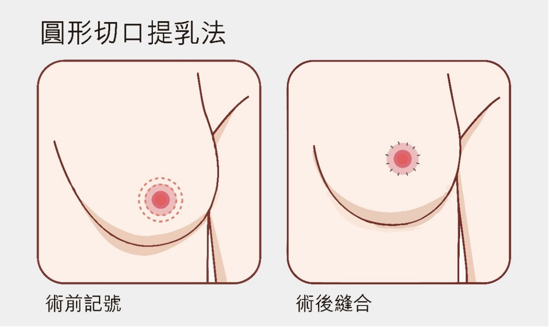 圖片環乳暈切口甜甜圈提乳示意圖