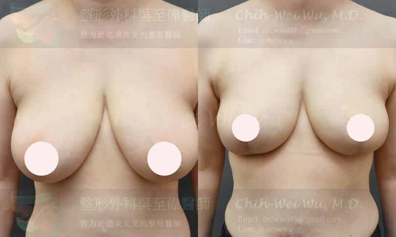 圖片2021年三月案例縮胸手術案例，縮胸手術權威吳至偉醫師
