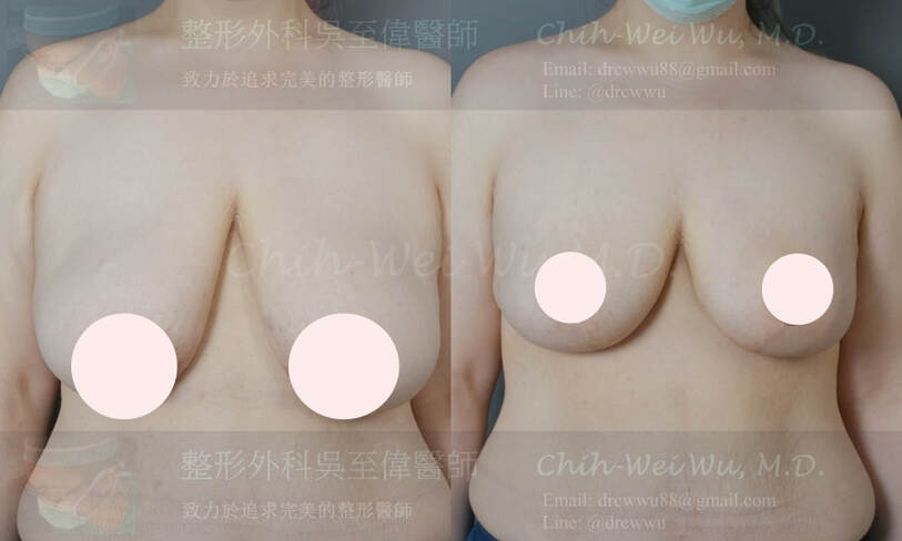 2021年三月案例縮胸手術案例，縮胸手術權威吳至偉醫師