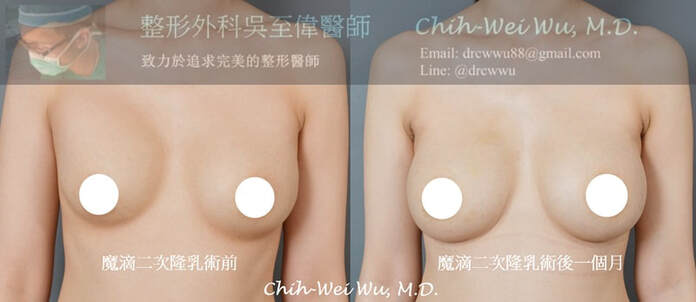▲ 此案例為三度莢膜攣縮，二次隆乳使用魔滴完成隆乳重建