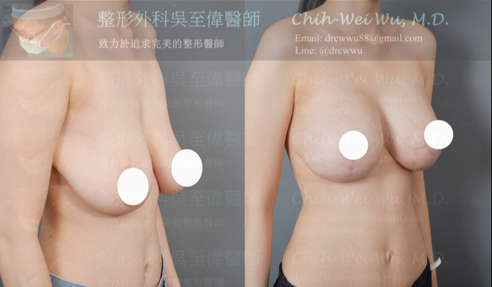 倒T切口+果凍矽膠提乳