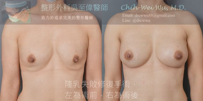 二次隆乳重建手術案例分享，假體位移，三度莢膜攣縮與明顯變形的胸部，經過吳至偉醫師施行二次隆乳失敗重建手術，患者重新回到自然對稱的胸形。