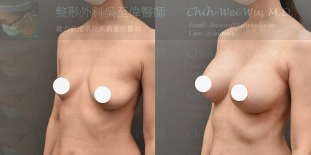 2020年8月最新提乳手術案例：產後隆乳在輕度乳房下垂的案例可以達到令人滿意的效果(提乳手術權威吳至偉醫師)