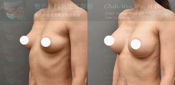 2020年8月最新提乳手術案例：假體隆乳在假性乳房下垂的案例可以達到非常好的隆乳提乳效果(提乳手術權威吳至偉醫師)