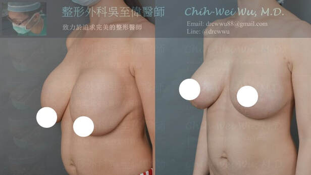 2020年10月最新提乳手術案例；原本的胸部因假體位置上移合併乳房下垂而變形，在提乳隆乳手術後，胸形豐滿且對稱自然，提乳手術權威吳至偉醫師