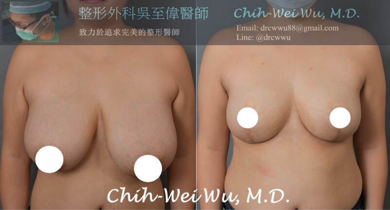 圖片2020年11月最新縮胸手術案例，H罩杯合併下垂與明顯不對稱的胸部，採用倒T切口縮胸手術，術後D罩杯，達到極好的對稱性與令人滿意的縮乳效果，縮乳手術權威吳至偉醫師