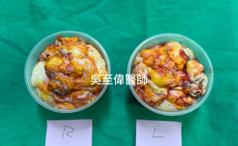 圖片兩側各切除500g，總共1公斤的組織