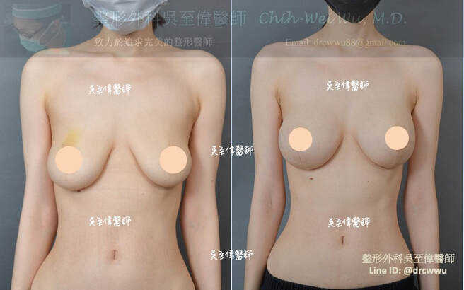 圖片棒棒糖提乳合併魔滴隆乳與大小胸調整