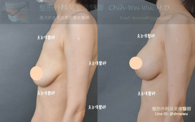 棒棒糖提乳合併魔滴隆乳與大小胸調整