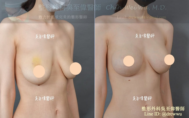 棒棒糖微笑提乳合併魔滴隆乳