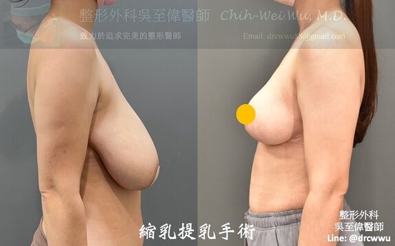 術前三度下垂的胸部，在提乳手術後達到令人滿意的上提效果，完整解決患者的困擾。