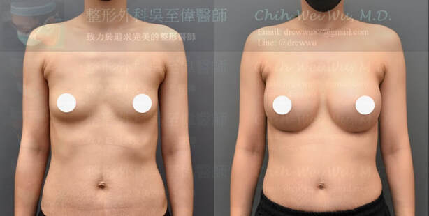 2020年最新提乳案例；患者原本約b罩杯，產後有明顯的萎縮鬆弛，在拉受假體隆乳後，胸形豐滿且對稱自然，提乳手術權威推薦