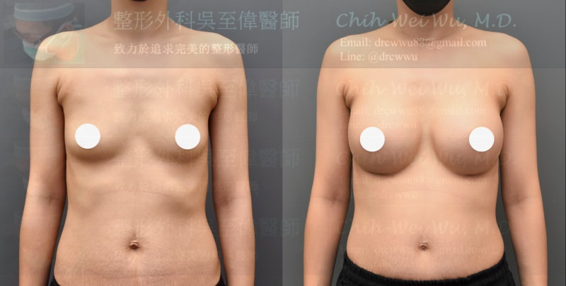 A罩杯隆乳案例照