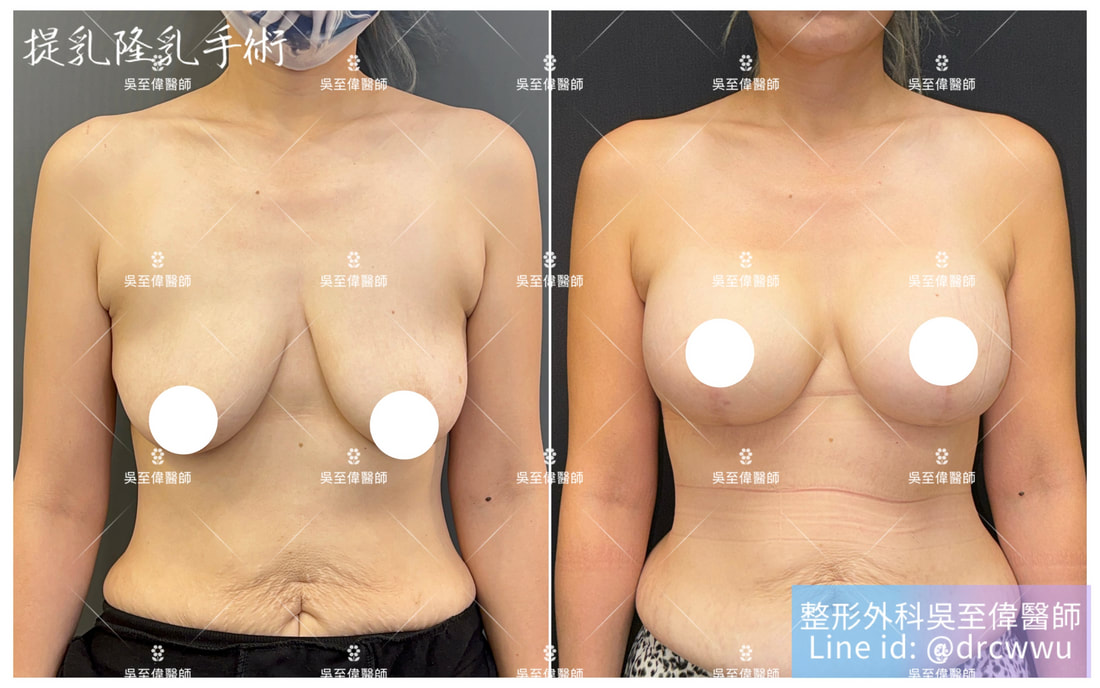 術前為二度下垂，棒棒糖提乳術後兩年，效果非常令人滿意