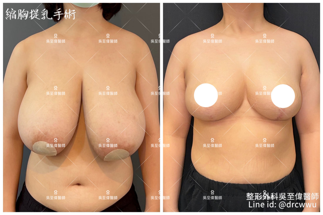 2024年三月更新，縮胸術後一年案例分享，從術前的H/I罩杯，改善到術後的D/E罩杯。縮胸手術權威吳至偉醫師