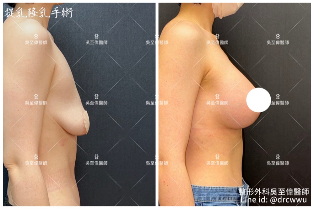 圖片2024年最新提乳案例，案例為二度下垂，手術採棒棒糖垂直切口，合併假體隆乳，術後四個月，胸形上挺，飽滿且呈現自然的弧度〔提乳權威吳至偉醫師〕