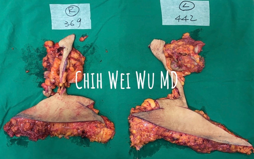 今天的縮胸提乳案例是生產過兩個小孩的媽媽，同時又接受過減重手術，造成胸部嚴重的下垂，在接受手術之後，單側切除的組織約400克，同時用脂肪填補上胸，預期可以減少三個罩杯,並達到飽滿的上胸