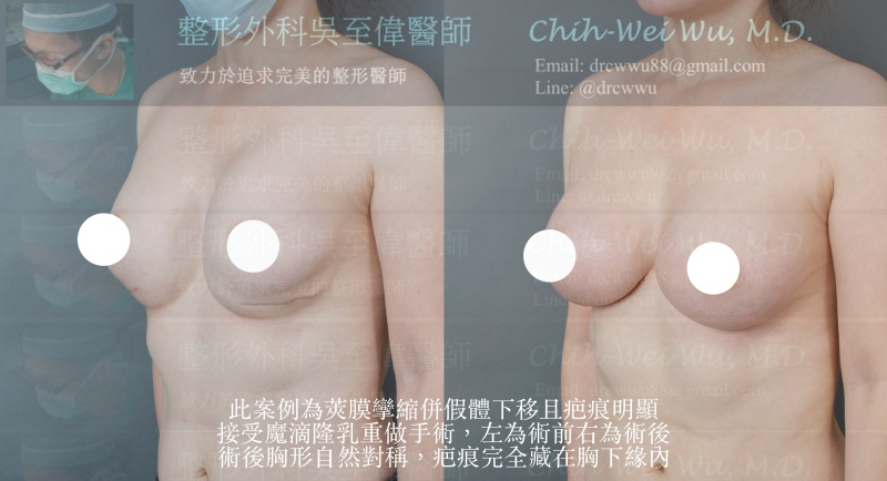 2020年7月二次隆乳案例，此案例為莢膜攣縮併假體下移且胸下疤痕明顯，接受魔滴隆乳重做手術，術後胸形自然，疤痕完全藏在胸下緣內，(隆乳失敗二次隆乳修復權威吳至偉醫師)