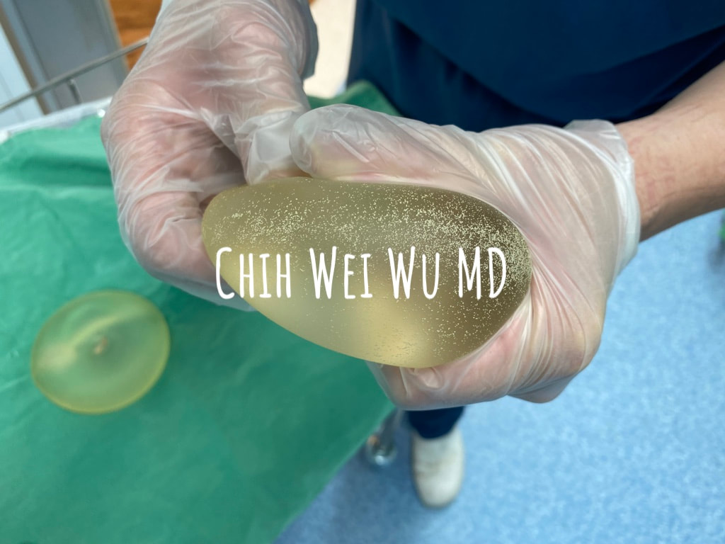 二次隆乳取出的假體，這個案例的假體在體內已經20年，算是非常久的假體了，因為夾饃攣縮的緣故，表面也有許多的鈣化。