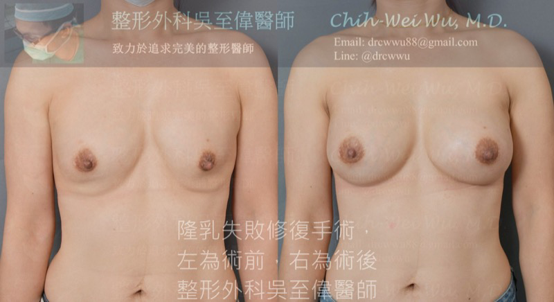 Picture 隆乳失敗修復案例